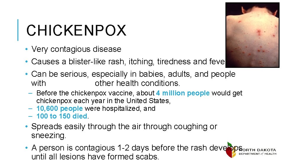 CHICKENPOX • Very contagious disease • Causes a blister-like rash, itching, tiredness and fever.