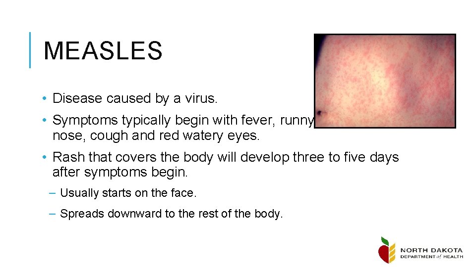 MEASLES • Disease caused by a virus. • Symptoms typically begin with fever, runny