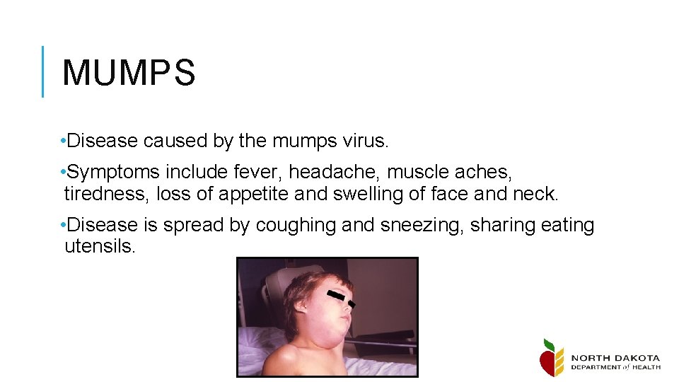 MUMPS • Disease caused by the mumps virus. • Symptoms include fever, headache, muscle