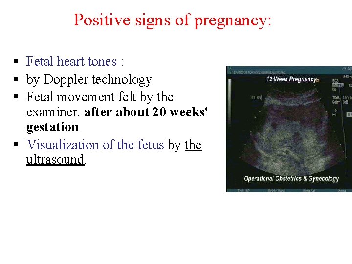 Positive signs of pregnancy: § Fetal heart tones : § by Doppler technology §