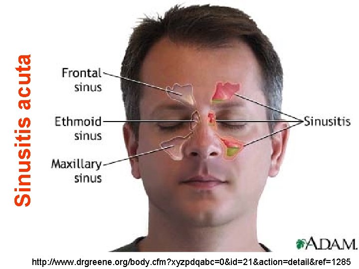 Sinusitis acuta http: //www. drgreene. org/body. cfm? xyzpdqabc=0&id=21&action=detail&ref=1285 