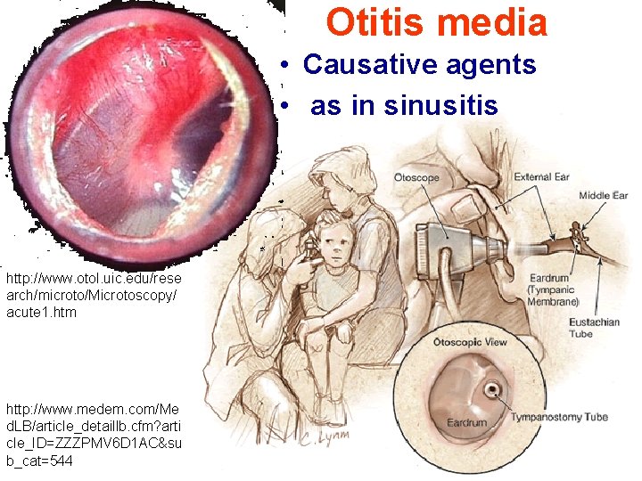 Otitis media • Causative agents • as in sinusitis http: //www. otol. uic. edu/rese