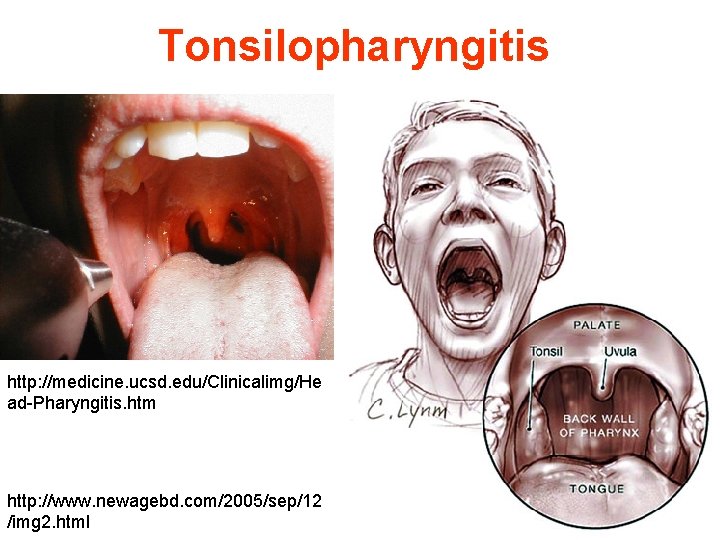 Tonsilopharyngitis http: //medicine. ucsd. edu/Clinicalimg/He ad-Pharyngitis. htm http: //www. newagebd. com/2005/sep/12 /img 2. html