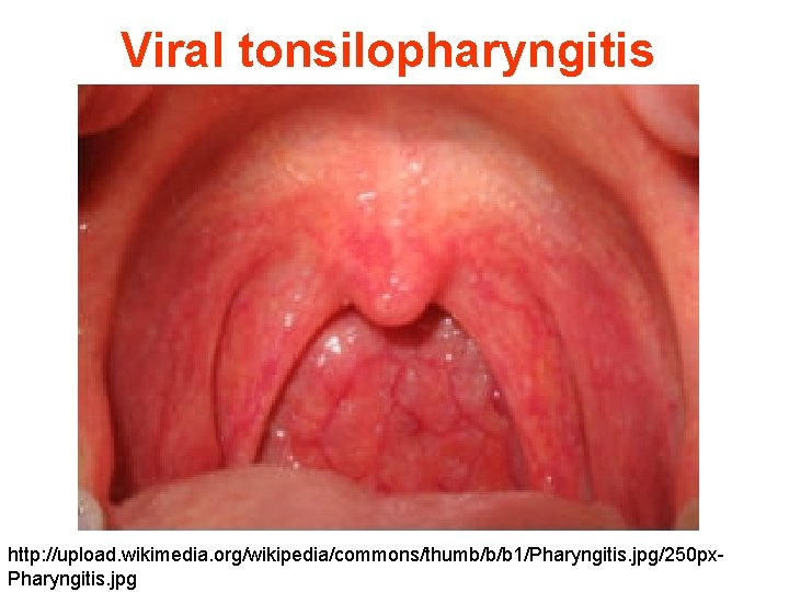 Viral tonsilopharyngitis http: //upload. wikimedia. org/wikipedia/commons/thumb/b/b 1/Pharyngitis. jpg/250 px. Pharyngitis. jpg 