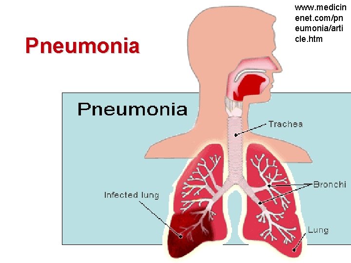 Pneumonia www. medicin enet. com/pn eumonia/arti cle. htm 
