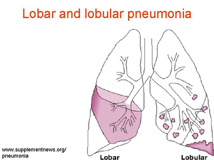 Lobar and lobular pneumonia www. supplementnews. org/ pneumonia 