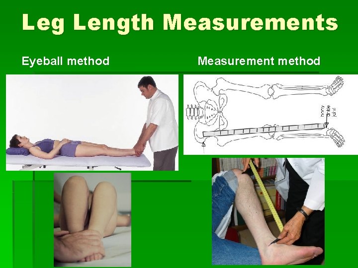 Leg Length Measurements Eyeball method Measurement method 