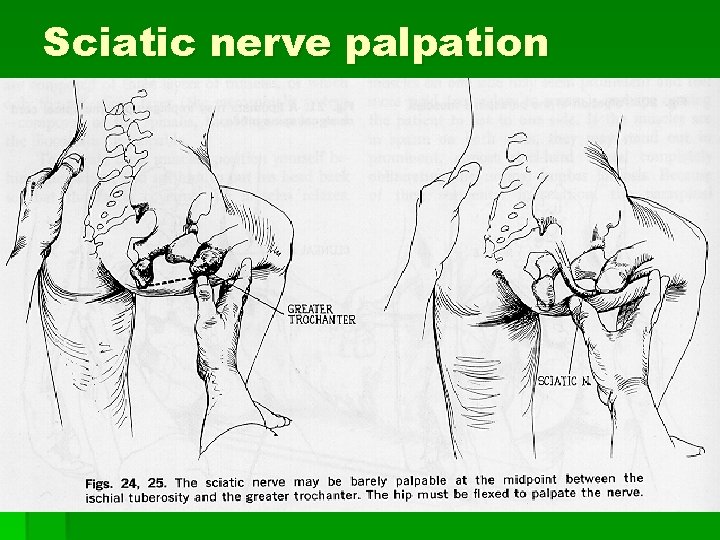 Sciatic nerve palpation 