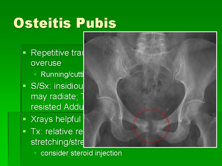 Osteitis Pubis § Repetitive trauma to pubic symphysis due to overuse § Running/cutting, esp