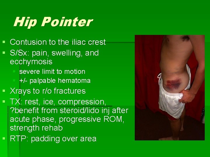 Hip Pointer § Contusion to the iliac crest § S/Sx: pain, swelling, and ecchymosis