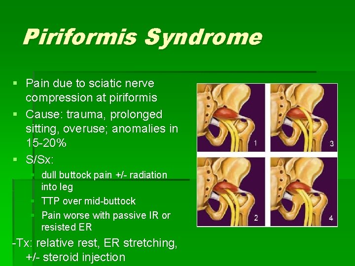 Piriformis Syndrome § Pain due to sciatic nerve compression at piriformis § Cause: trauma,