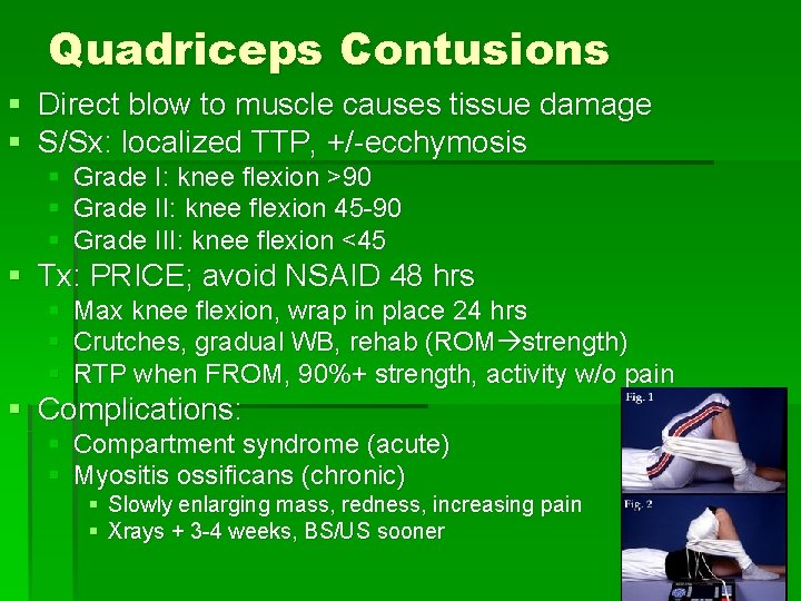 Quadriceps Contusions § Direct blow to muscle causes tissue damage § S/Sx: localized TTP,