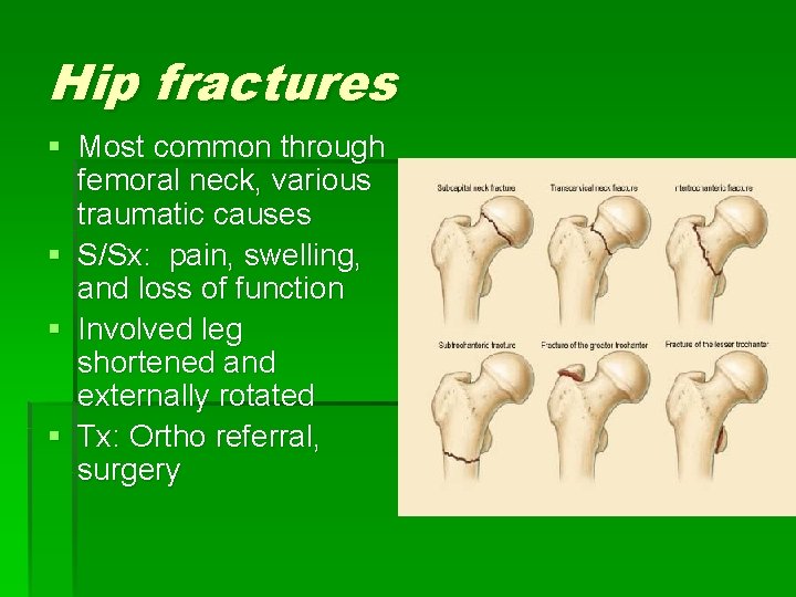 Hip fractures § Most common through femoral neck, various traumatic causes § S/Sx: pain,