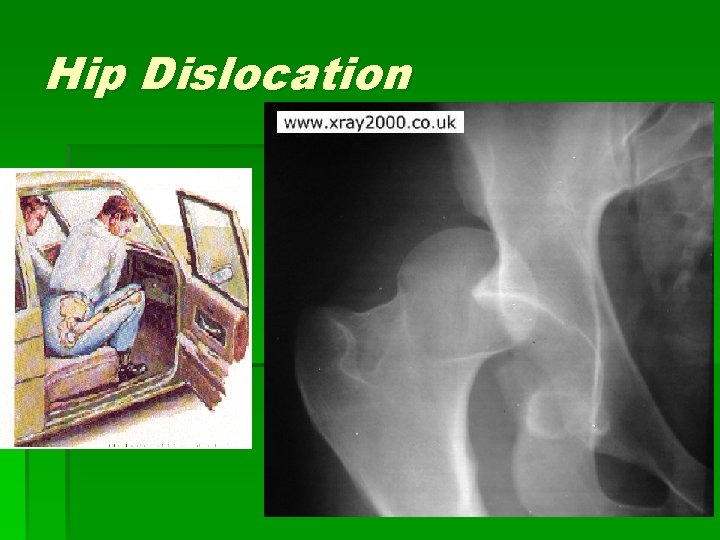 Hip Dislocation § Femoral head usually goes posteriorly § common mechanism: knee to dashboard