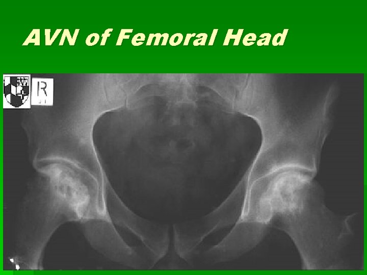 AVN of Femoral Head § Causes: § Trauma: fxs, hip dislocation, surgery § Medical