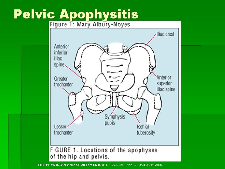 Pelvic Apophysitis THE PHYSICIAN AND SPORTSMEDICINE - VOL 29 - NO. 1 - JANUARY