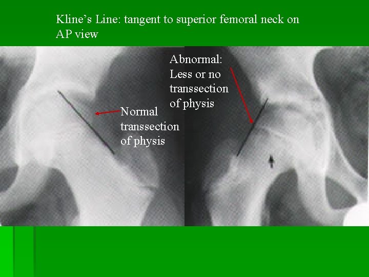 Kline’s Line: tangent to superior femoral neck on AP view Abnormal: Less or no