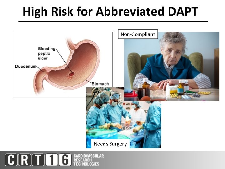 High Risk for Abbreviated DAPT Non-Compliant Needs Surgery 