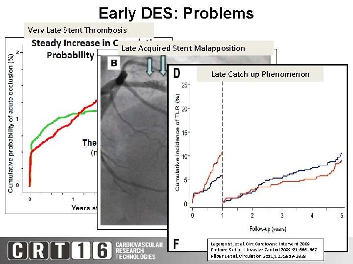 Early DES: Problems Very Late Stent Thrombosis Late Acquired Stent Malapposition Late Catch up