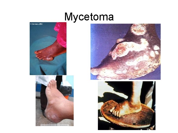 Mycetoma 