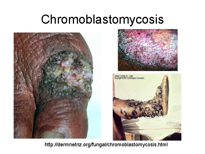 Chromoblastomycosis http: //dermnetnz. org/fungal/chromoblastomycosis. html 