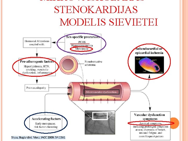 MIKROVASKULĀRAS STENOKARDIJAS MODELIS SIEVIETEI 