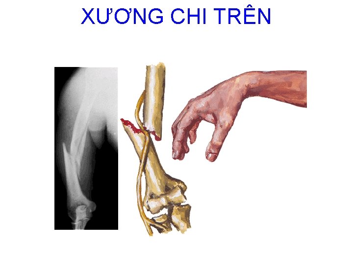 XƯƠNG CHI TRÊN 