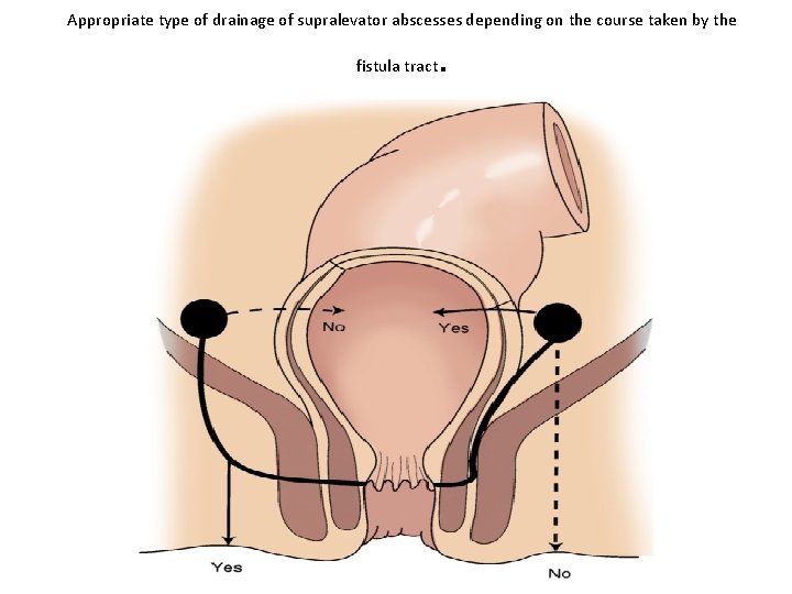 Appropriate type of drainage of supralevator abscesses depending on the course taken by the