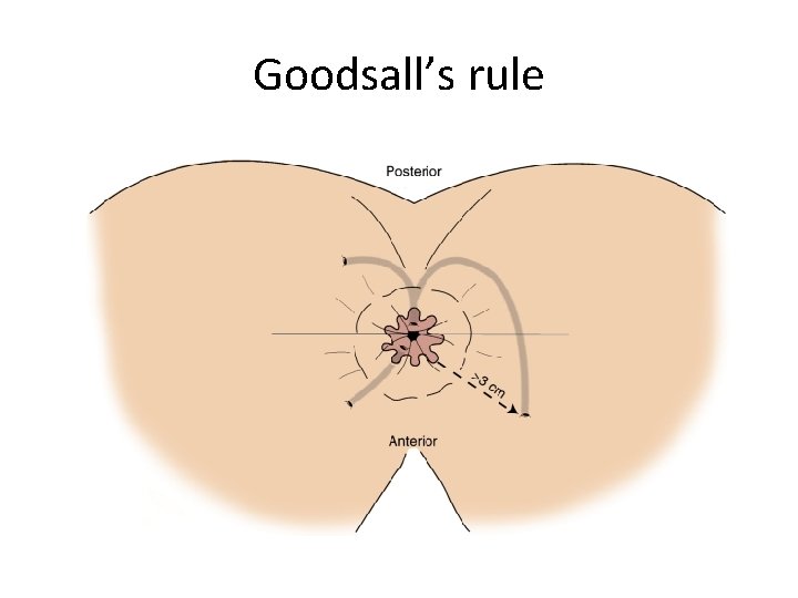 Goodsall’s rule 