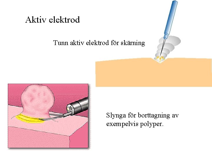 Aktiv elektrod Tunn aktiv elektrod för skärning Slynga för borttagning av exempelvis polyper. 