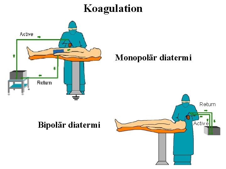 Koagulation Monopolär diatermi Bipolär diatermi 