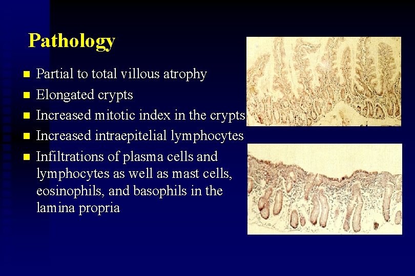 Pathology n n n Partial to total villous atrophy Elongated crypts Increased mitotic index