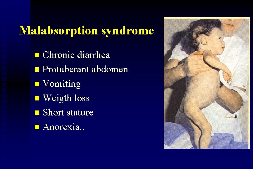 Malabsorption syndrome Chronic diarrhea n Protuberant abdomen n Vomiting n Weigth loss n Short