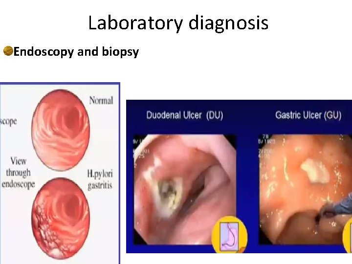 Laboratory diagnosis Endoscopy and biopsy 