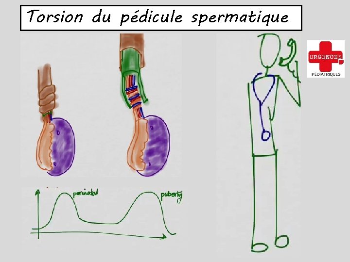 Torsion du pédicule spermatique 