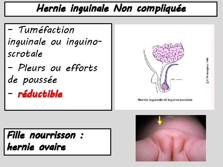 Hernie inguinale Non compliquée – Tuméfaction inguinale ou inguinoscrotale – Pleurs ou efforts de