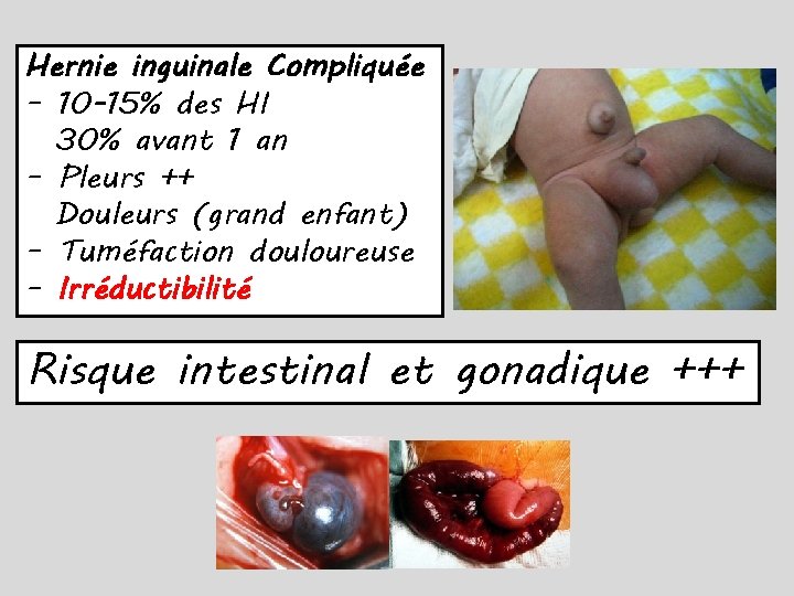 Hernie inguinale Compliquée – 10 -15% des HI 30% avant 1 an – Pleurs