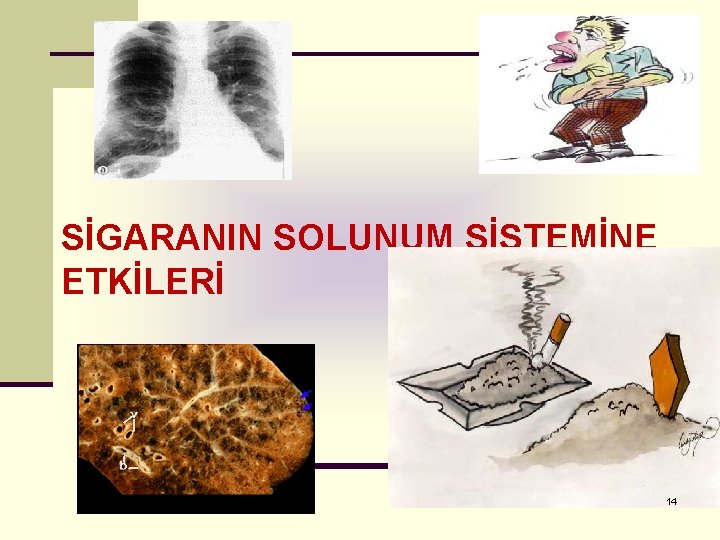 SİGARANIN SOLUNUM SİSTEMİNE ETKİLERİ 14 