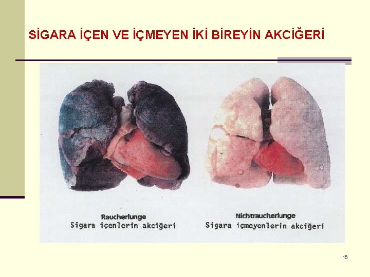 SİGARA İÇEN VE İÇMEYEN İKİ BİREYİN AKCİĞERİ 16 