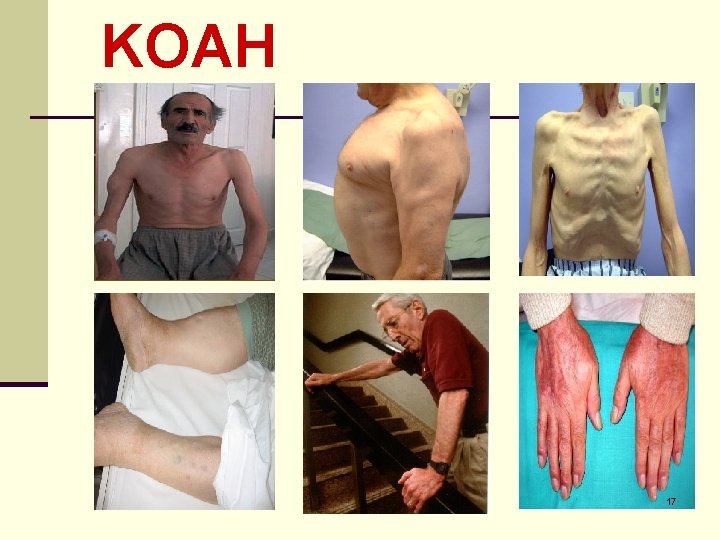 KOAH 17 