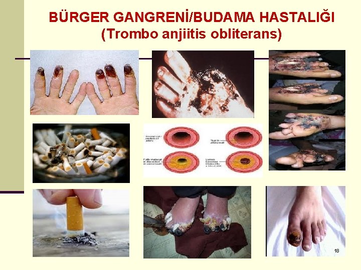 BÜRGER GANGRENİ/BUDAMA HASTALIĞI (Trombo anjiitis obliterans) 18 