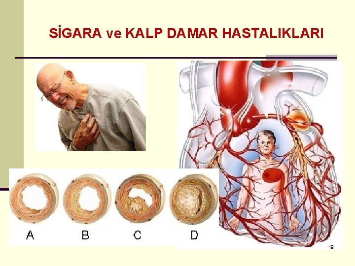 SİGARA ve KALP DAMAR HASTALIKLARI 19 