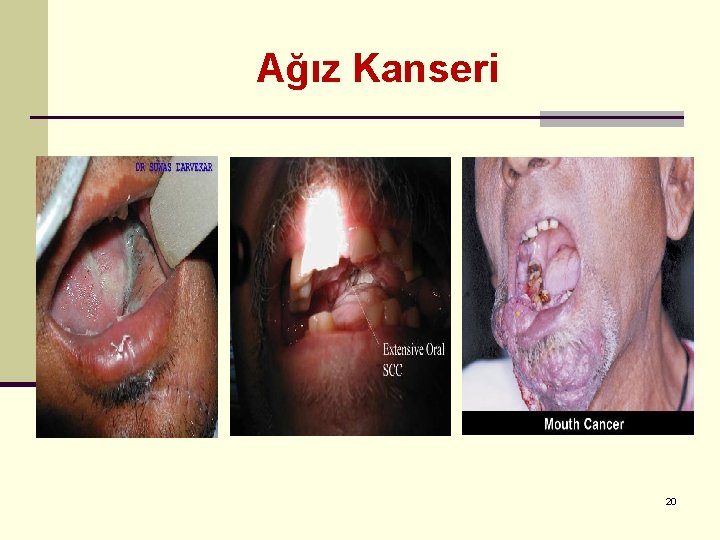 Ağız Kanseri 20 