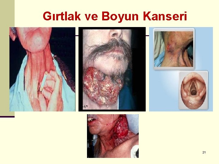 Gırtlak ve Boyun Kanseri 21 