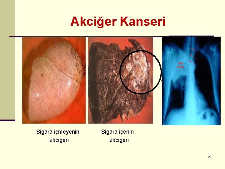 Akciğer Kanseri Kanserli Bölge Sigara içmeyenin akciğeri Sigara içenin akciğeri 22 