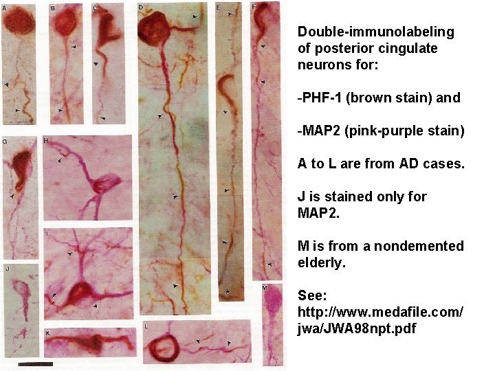 Double-immunolabeling of posterior cingulate neurons for: -PHF-1 (brown stain) and -MAP 2 (pink-purple stain)