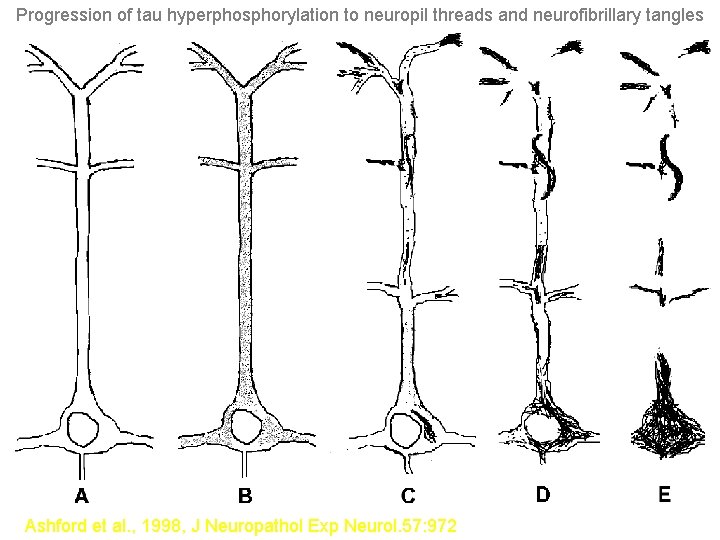 Progression of tau hyperphosphorylation to neuropil threads and neurofibrillary tangles Ashford et al. ,