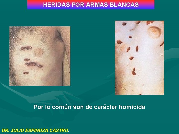 HERIDAS POR ARMAS BLANCAS Por lo común son de carácter homicida DR. JULIO ESPINOZA