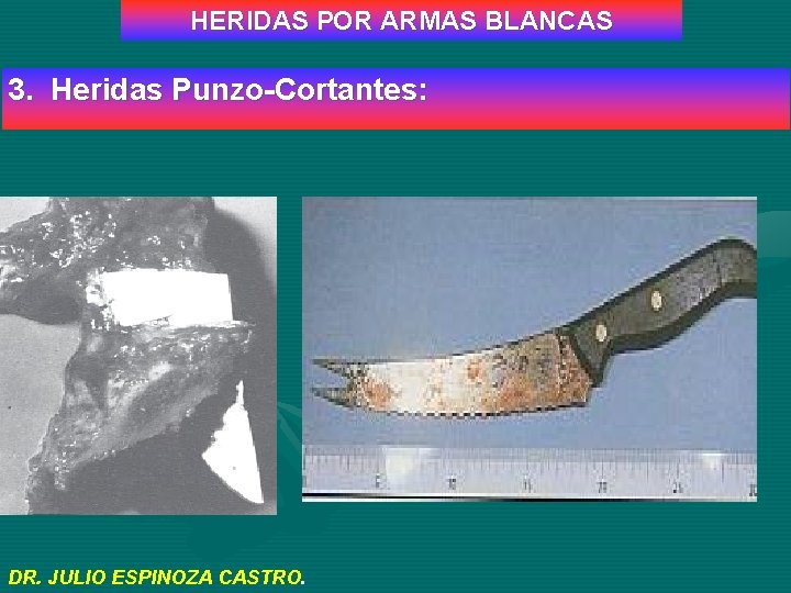 HERIDAS POR ARMAS BLANCAS 3. Heridas Punzo-Cortantes: DR. JULIO ESPINOZA CASTRO. 