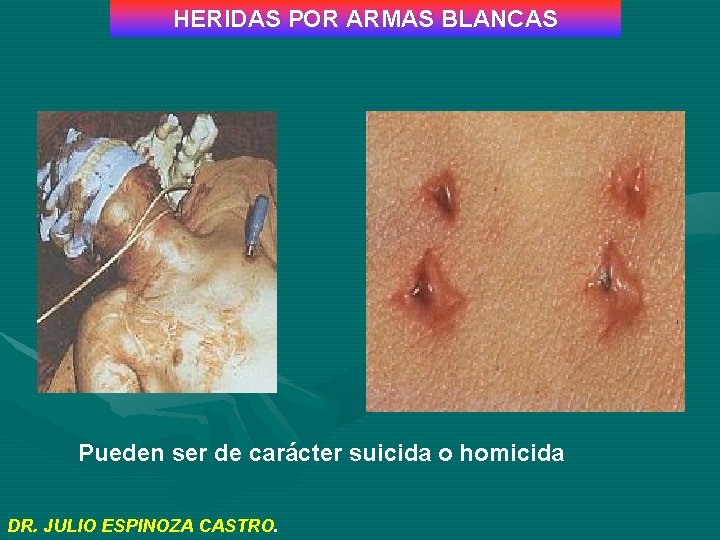 HERIDAS POR ARMAS BLANCAS Pueden ser de carácter suicida o homicida DR. JULIO ESPINOZA